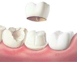 Dental Crowns Brampton