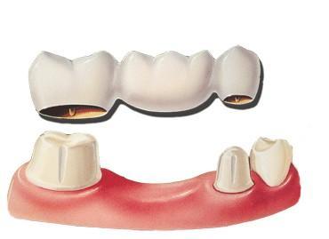 Dental Bridges Brampton