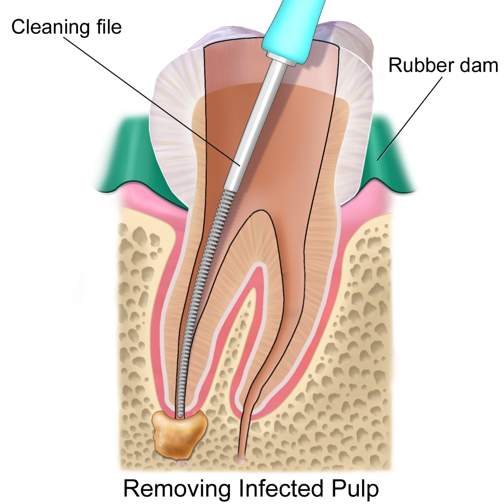 Root Canal Brampton