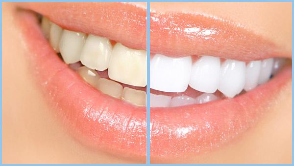 Teeth Whitening in Brampton