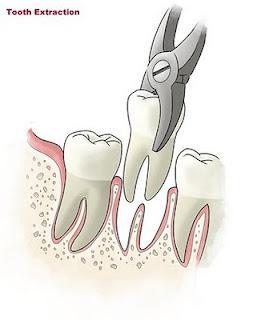 Tooth Extractions Brampton